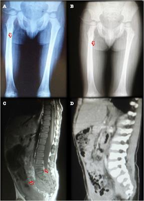 Multifocal Recurrent Osteomyelitis and Hemophagocytic Lymphohistiocytosis in a Boy with Partial Dominant IFN-γR1 Deficiency: Case Report and Review of the Literature